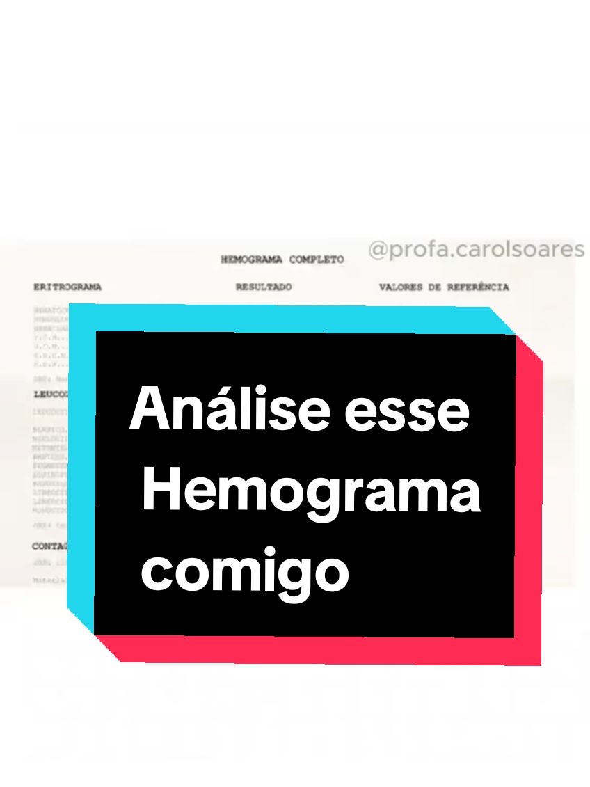 🔬 Vamos mergulhar na análise deste hemograma que apresenta um quadro interessante! O exame mostra alterações significativas na série vermelha, com aumento da hemoglobina e hematócrito, indicando hemoconcentração. No leucograma, observamos leucocitose com linfocitose, sugestivo de infecção viral. O plaquetograma revela plaquetopenia, possivelmente causada pelo tropismo viral. 👩⚕️ Quer aprender a interpretar exames laboratoriais com segurança e precisão? Acesse meu curso 