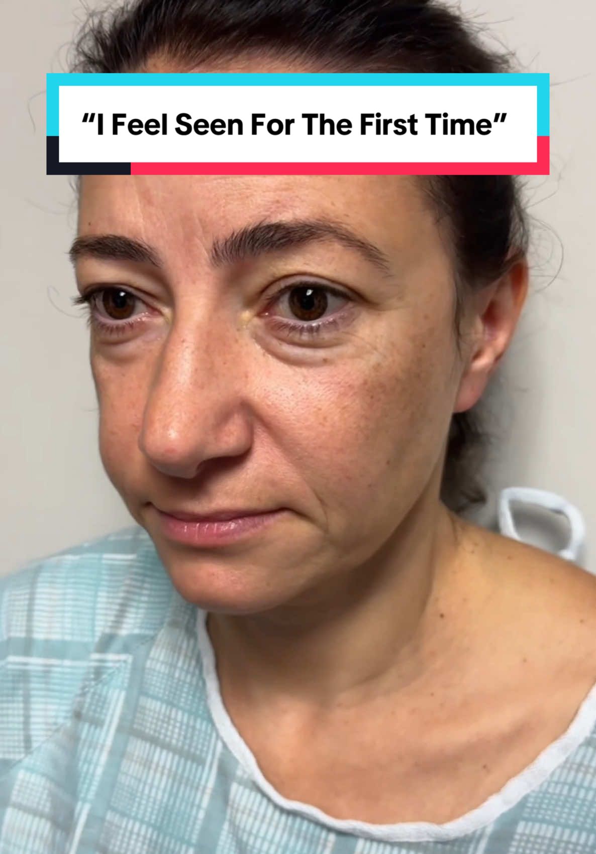 Endoscopic Browfecta Lift includes: Upper blepharoplasty, lower blepharoplasty, fat transfer to mid-face + skin tightening. 📍Beverly Hills, CA. #eyes #eyebags #darkcircles #browlift #hoodedeyes #kamiparsa #puffyeyes #blepharoplasty 