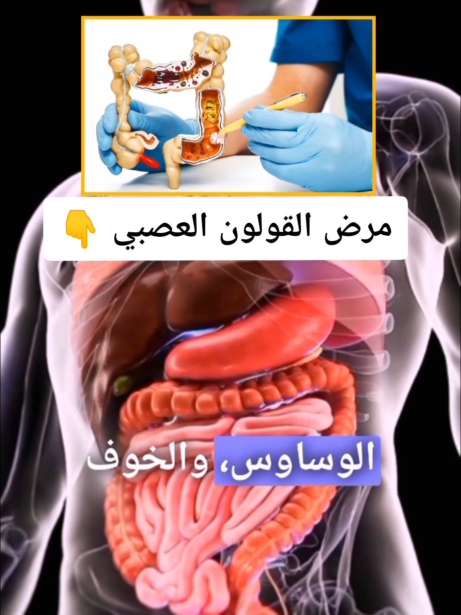 مرض القولون العصبي #القولون #القولون_العصبي #الجهاز_الهضمي #الحجامة_العلاجية #hijama #الحجامة #cupping 