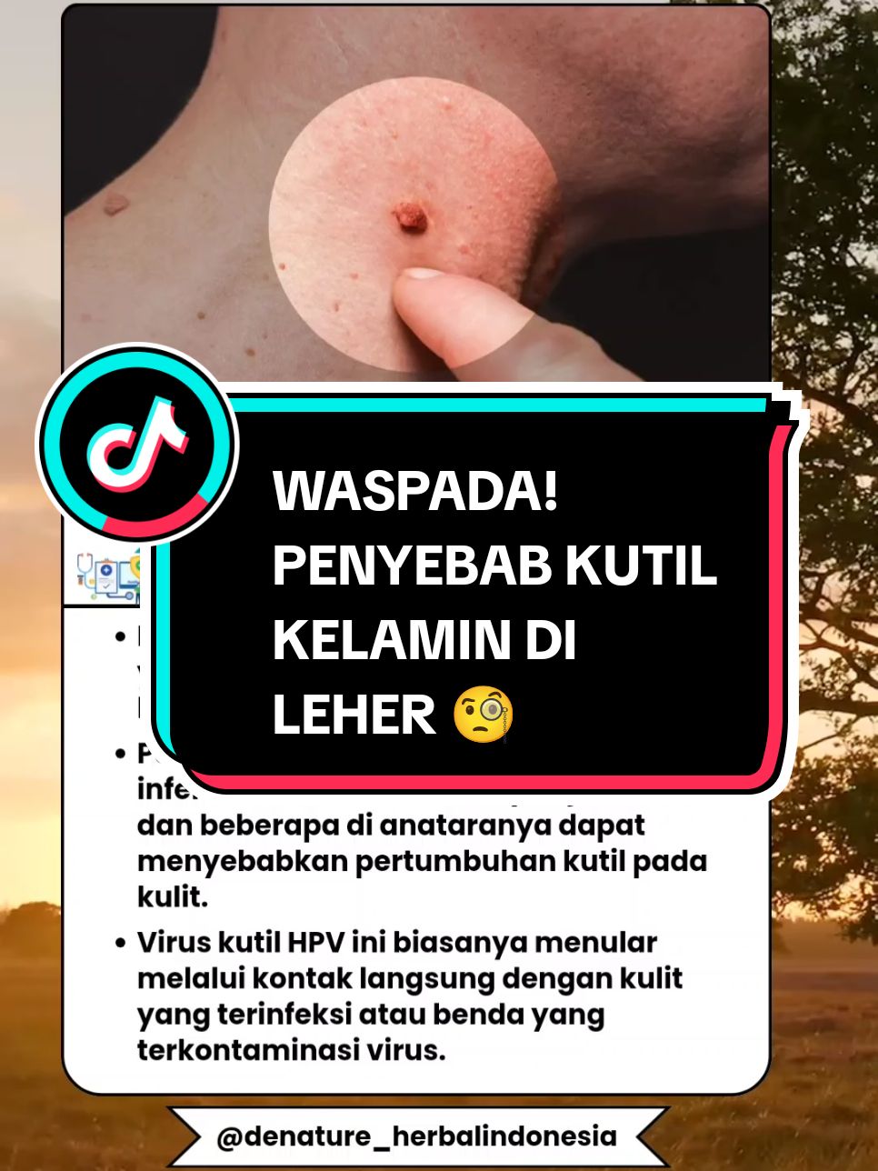 • Kutil di leher adalah pertumbuhan kulit yang tidak normal akibat infeksi virus human papillomavirus {HPV}. • Penyebab utama kutil di leher adalah infeksi virus HPV. Ada banyak jenis HPV, da beberapa di anataranya dapat menyebabkan pertumbuhan kutil pada kulit. • Virus kutil HPV ini biasanya menular melalui kontak langsung dengan kulit yang terinfeksi atau benda yang terkontaminasi virus. #fypシ゚ #maddebicoil #kutil #kutildileher #kutilkemaluan #kondilomataakuminata #kutildileher #viraltiktok #soundviral #fyppppppppppppp 