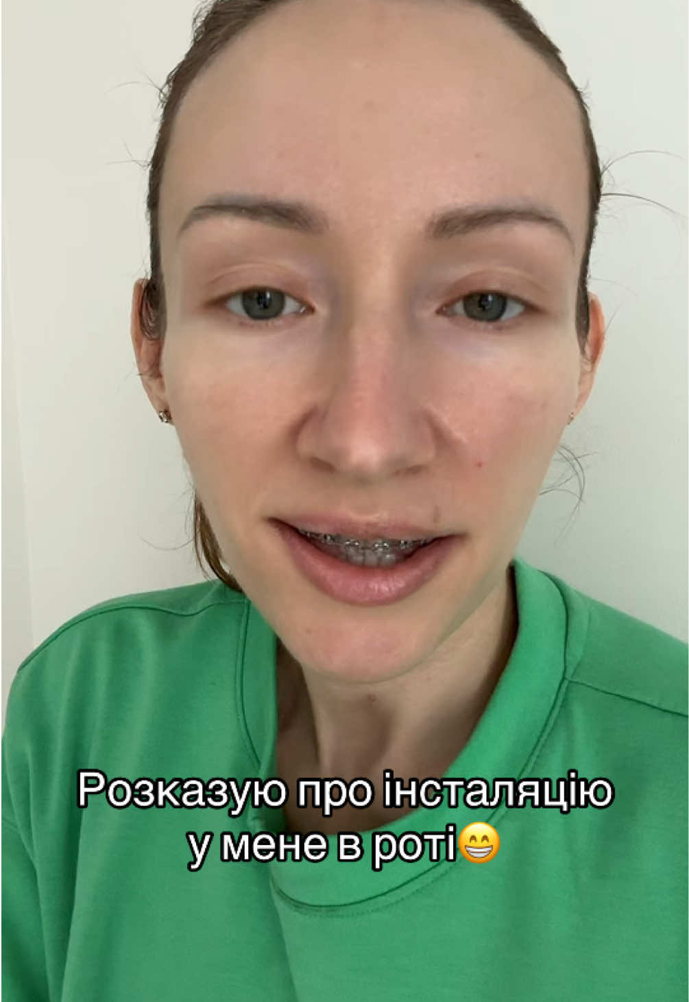 Розказую що за інсталяція у мене в роті. Там #forsus для висування вперед нижньої щелепи #hyrax для розширення верхньої щелепи, брекети які чипляються за мікро імплантат в верхній щелепі і мають її підіймати. Ще поставиди стовпчики на зуби для опори, бо зуби не змикаються. Виглядає страшно вле в принципі жити можна😁 #ортодонт #ортодонтичнелікування 