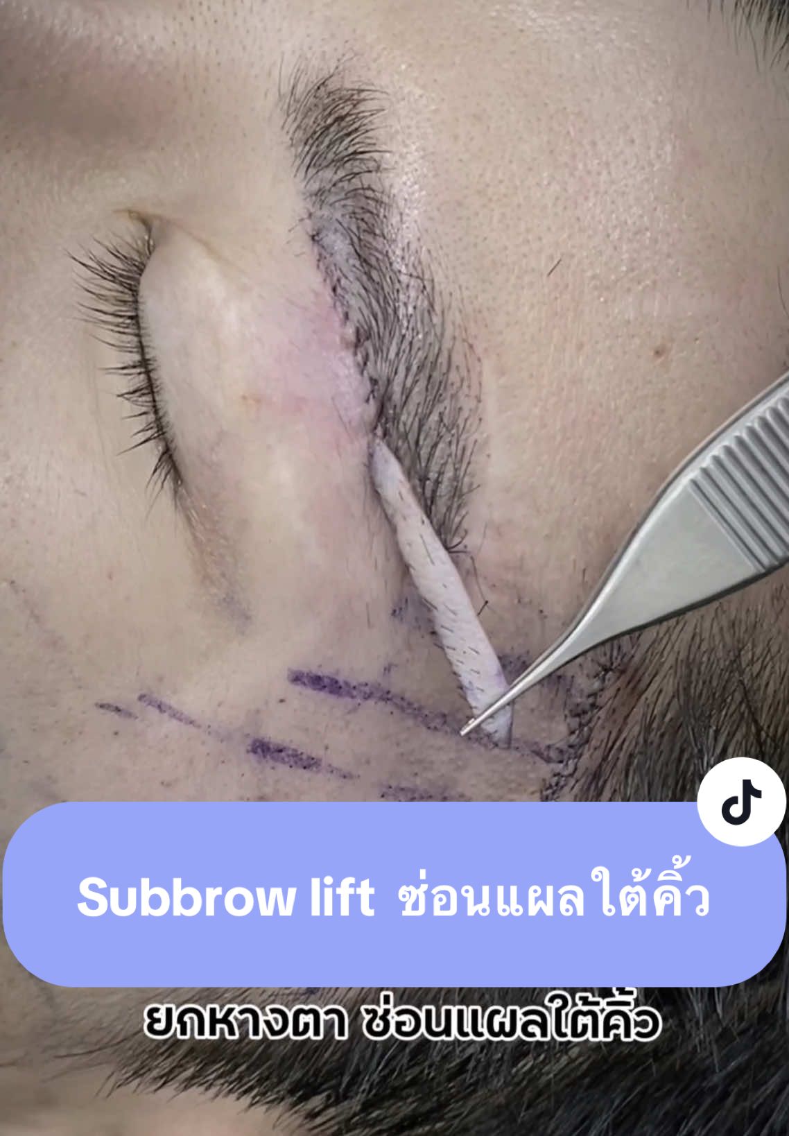 ใครมีปัญหา #หนังตาตก หน้าดูเศร้า ต้องแก้ไขด้วย #subbrowlift ยกหางตา ซ่อนแผลใต้คิ้ว โดย #หมอเฟิร์นnsc @หมอเฟิร์น NSC CLINIC แผลสวย เนียนกริบ ✅ ต้องที่ nscclinic 