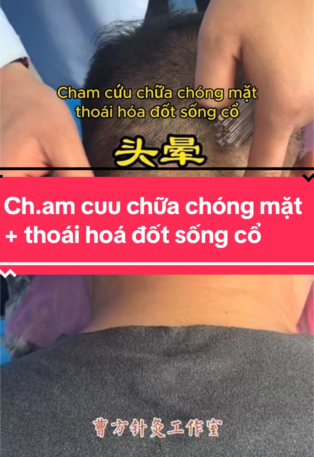 Cham cuu chữa chóng mặt + thoái hoá đốt sống cổ 🥰✅☝️ #chamcuu #xoabopbamhuyet #yhoccotruyen #yhcttrunghoa #thoaihoadotsongco #chongmat 