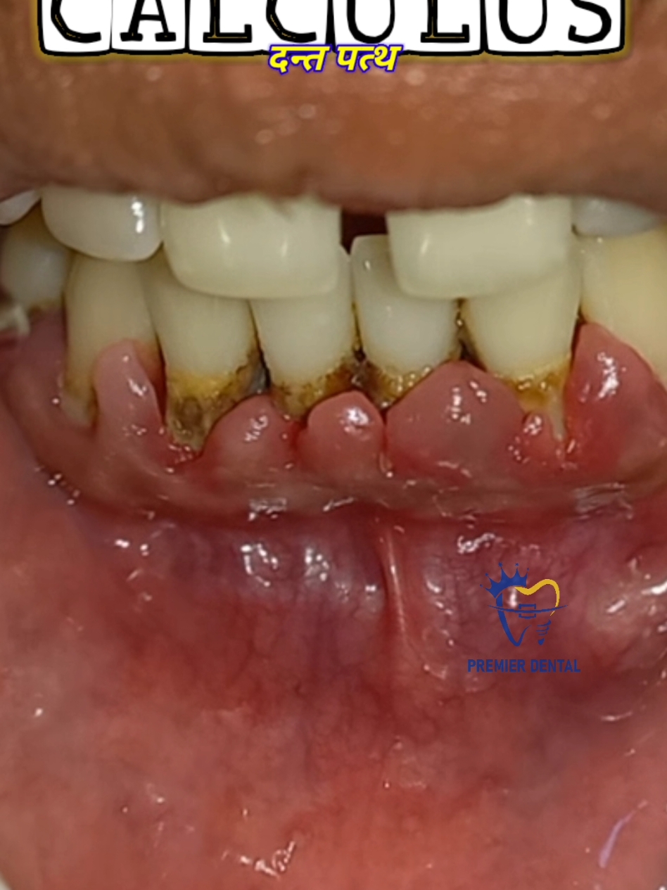 Dental calculus deposit is the second most cause of tooth loss followed by Dental caries. Regular dental checkup every 6 months followed by professional tooth cleaning can save tooth lifetime. #stayaware #periodontitis #toothmobility #tooth #oralhealth #दाँत #दन्तस्बास्थय #दन्तचिकित्सक #प्रिमियरडेन्टल #नेपालीडेन्टिष्ट #savetooth #premierdentalnepal #dentist #drbiplob #awareness #scaling #calculus #gumdissase #badbreath 