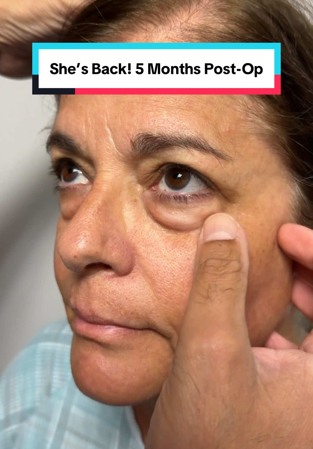 Trifecta Lift = lower blepharoplasty + fat transfer to mid-face + skin tightening. 📍Beverly Hills, CA  #eyebags #darkcircles #kamiparsa #darkcircles #blepharoplasty #puffyeyes