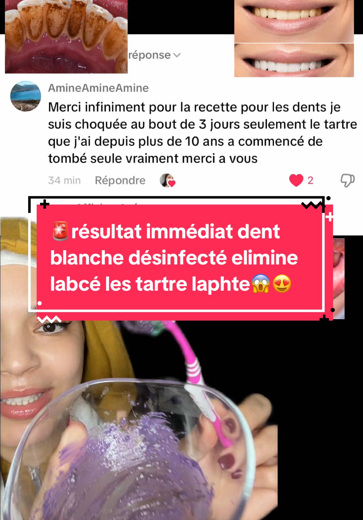 🚨résultat immédiat dent blanche désinfecté elimine labcé les tartre laphte😱😍 . . . #dentista #dentjaune #blanchirsesdents #dentistaentiktok #ingredientesnaturales #aphtes #tartre #abces @Douha laribii @Rahma laribi  @Big bos  @Big bos  @Big bos 