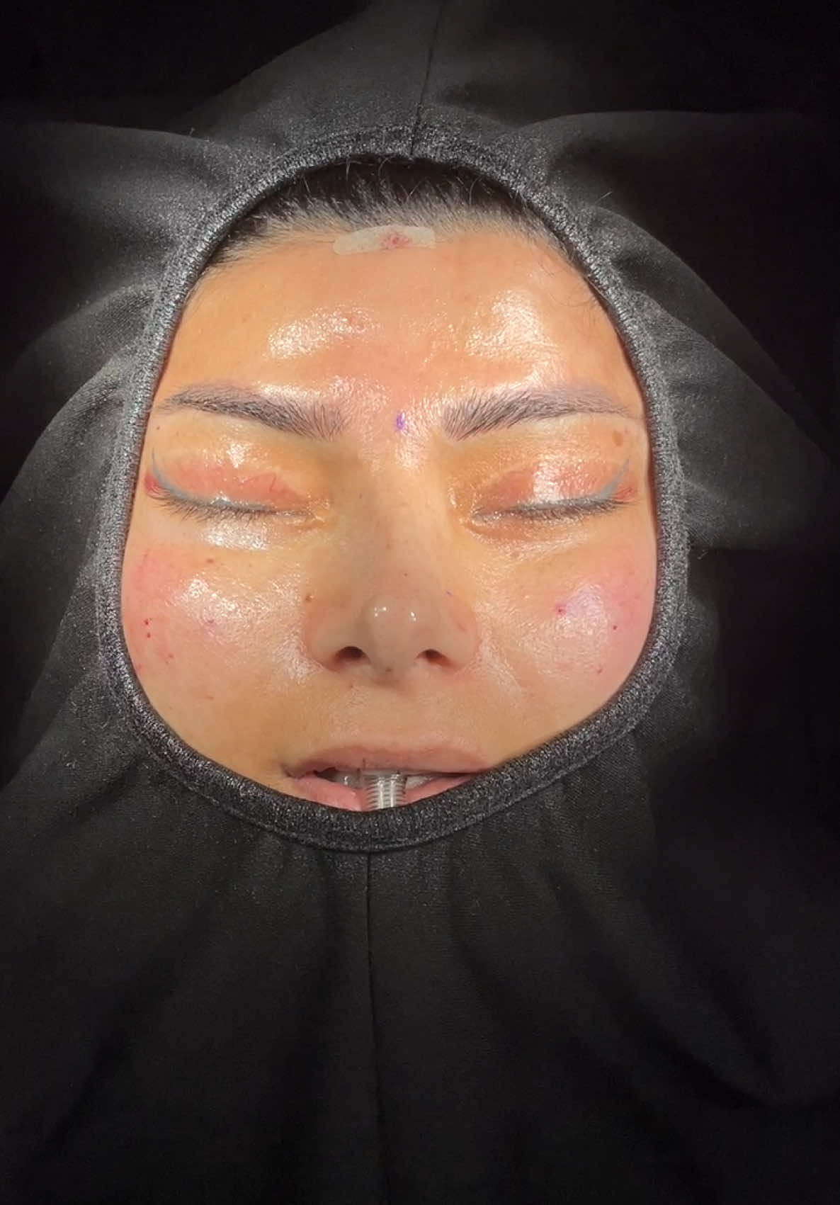 Fox eyes & Temporallift & Cat Eyes 👁️  . . . . #temporallift#foxeyes#cateyes#midfaceliftturkey#midfacelift#temporalliftturkey#foxeyesturkey#cateyesturkey