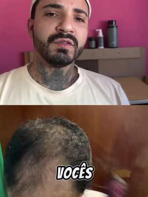 Queda de Cabelo tem tratamento!