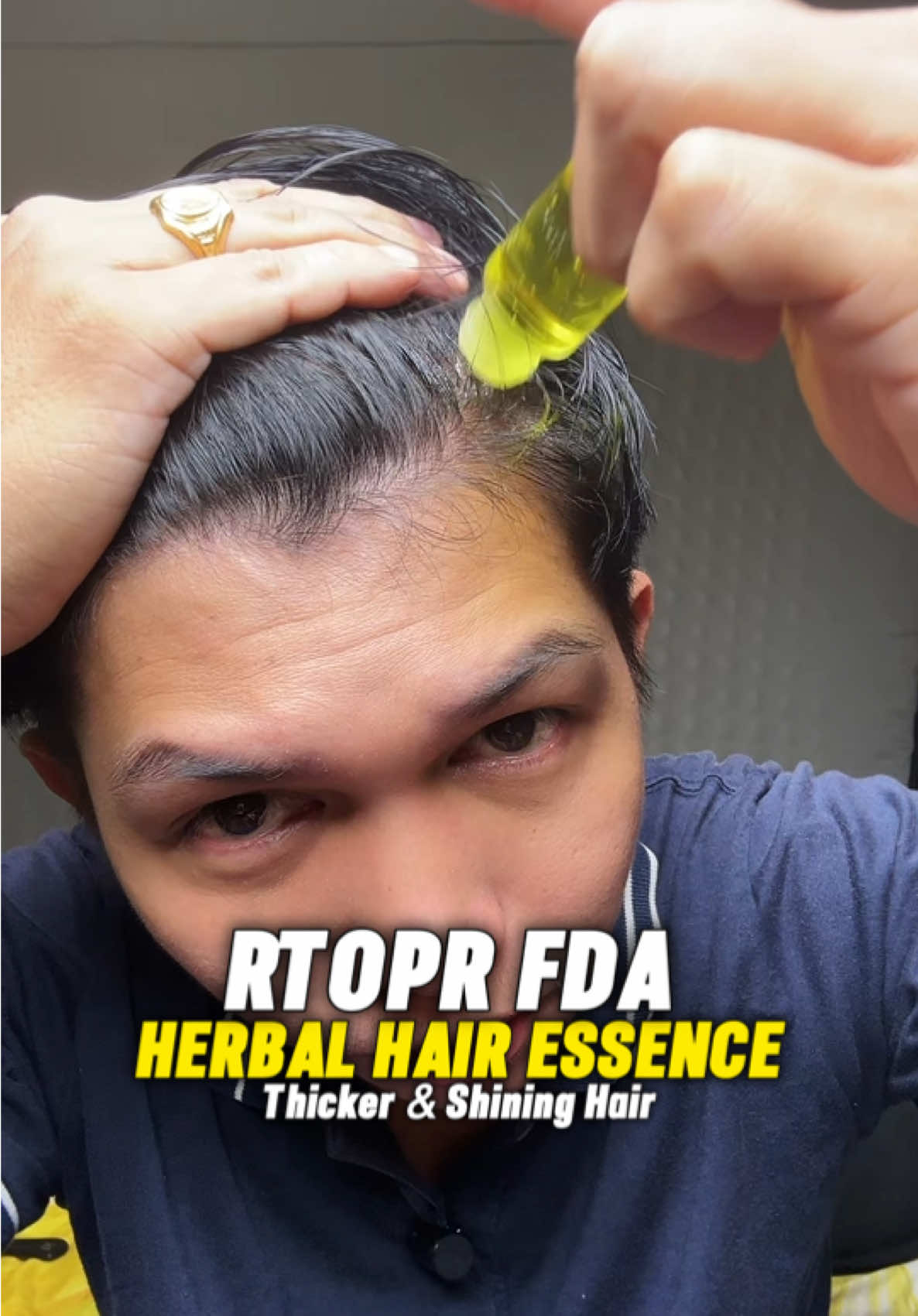 RTOPR Hair growth Anti Hair Loss Hair Essence FDA Approved #RTOPR #HairGrowth #AntiHairLoss #FDA #FdaApproved #fyp 