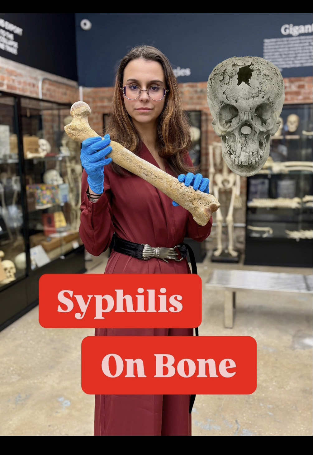 🦴 Did you know syphilis can leave its mark on the skeleton? In this video, we’re diving into how this infection causes periosteal inflammation, leading to abnormal growth in long bones like the femur. 🩺✨ These changes result from the body’s response to chronic infection, creating new layers of bone that give us a unique window into the past. 🔍 Join us as we uncover the fascinating connection between disease and skeletal anatomy, and learn how bones tell stories of health, history, and human resilience. 🌟🦷 #bonetok #osteology #syphilis 