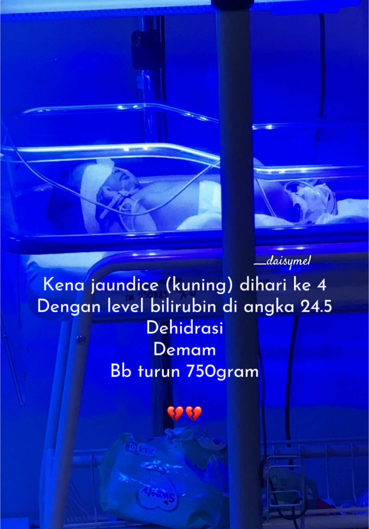 Sebagai ibu ibu yang idealis saat itu, aku pun menuruti saran mayoritas pihak yang bilang “jangan buru buru kasih sufor, usahain ASI. bayi baru lahir bisa kuat tanpa makan 3 hari kok” padahal, orang tua ku, mertuaku; smua udah menyarankan gapapa sufor dlu aja kalau mmg ASI belum kluar. Akhirnya, anakku malah terkena jaundice dengan level nyaris fatal. Dimana bisa kalian cek level bilirubin yg dianggap fatal itu di level 25, anakku di 24.5😭 #bilirubintinggi #jaundice #bayikuning #bayilucu 