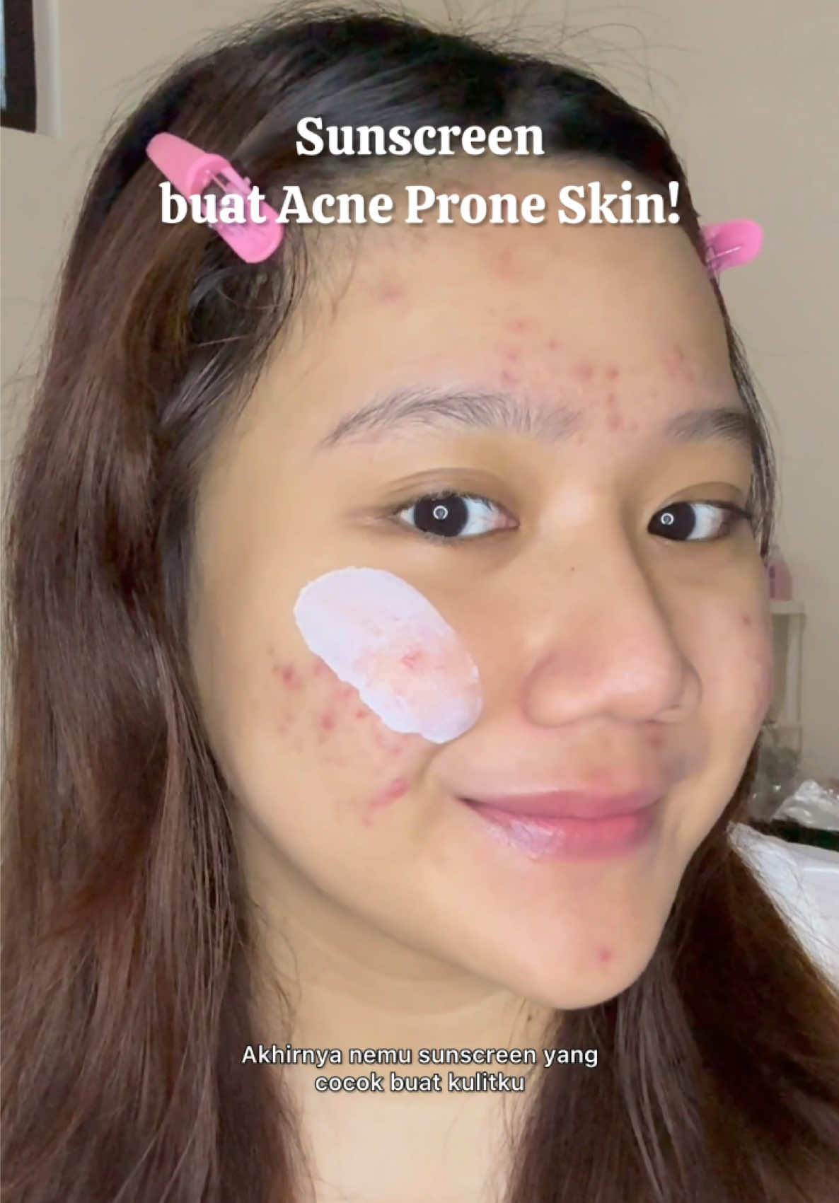 Sunscreen yg APPROVED buat pemilik Acne Prone Skin🩷✨ #onlyoubeauty #kulitjerawat #kulitsensitif #skincareonlyou #waterysunscreenonlyou #onlyousunscreen #rekomendasisunscreen #sensitiveskin #glowing #onlyou 