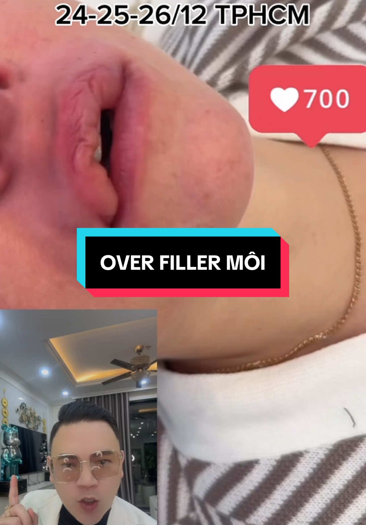 Sau khi over filler môi # #reviewlamdep #thammy #LearnOnTikTok #xuhuong #goclamdep #filler #botox #fillerbotox #tiemfiller #lamdepkhongkho #lamdepmoingay #bacsihongtm 