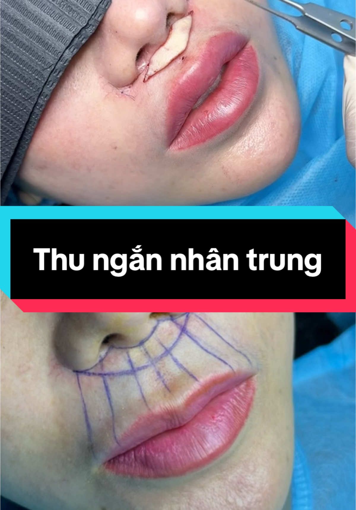 Trên dài mỏng cup và phẳng. Tiem fillernhiều nhưng vẫn không lên dáng. Thu ngắn nhân trung là một ppháp khắc phục hết tất cả các nhược điểm trên.#th#thungannhantrungi#midangu#xuhuongh#thammynoikhoa