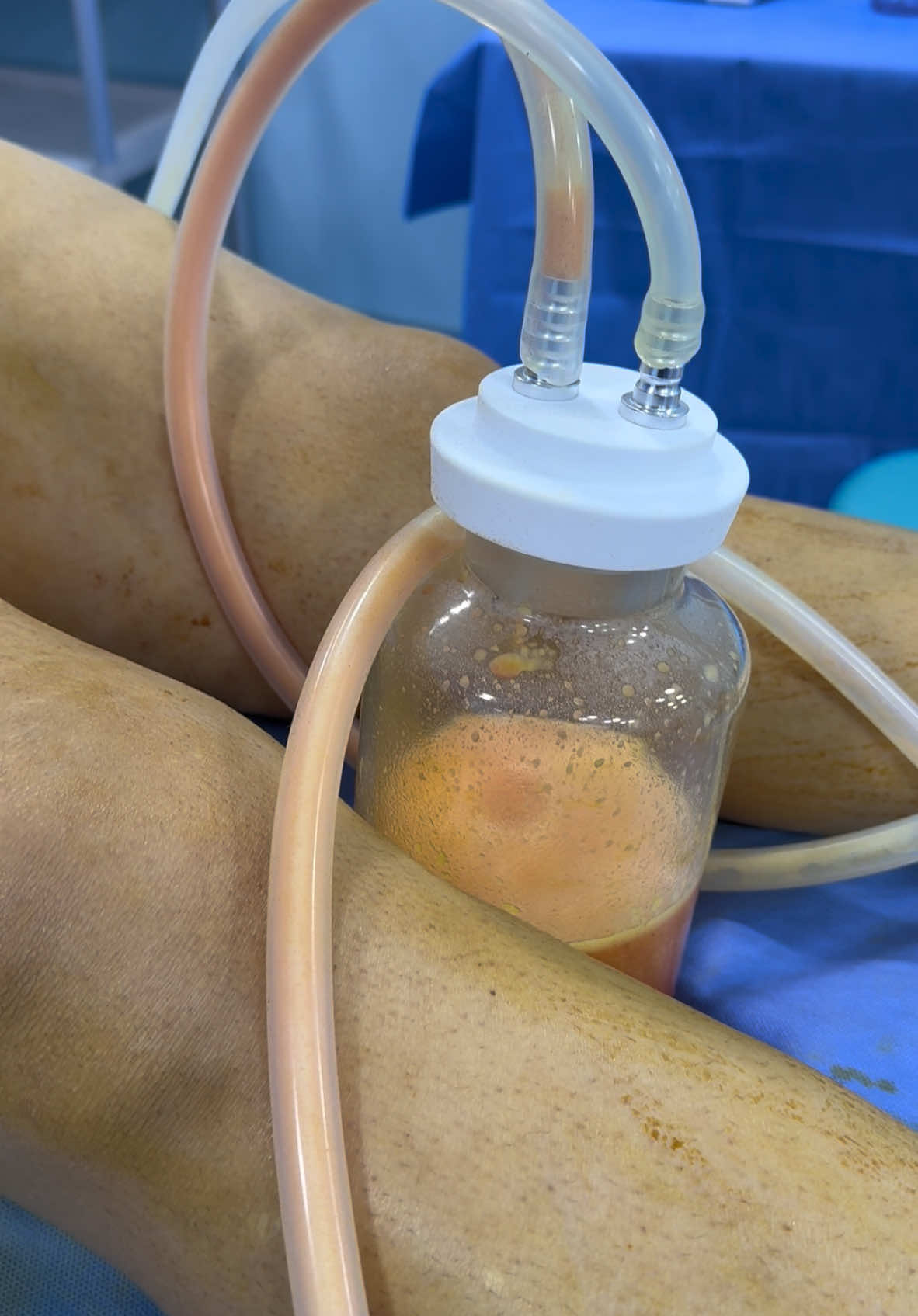 #liposuction #شفط_الدهون #liposuccion #chirurgieesthetique #زرع_الدهون #lipofillig #fattransfer 