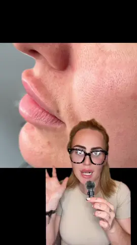 Lip Filler Migration: Why You Shouldn’t Ignore It 👄💉 In this video, I dive into two detailed cases of lip filler migration and explain exactly what went wrong. I show you how filler can move beyond the natural lip border—sometimes into the upper lip area, creating that dreaded ‘duck lip’ look, or even spreading to surrounding tissues, causing unevenness and swelling. I also clear up some common myths about dissolving lip fillers: 	✅ It’s NOT excruciatingly painful (ignore the horror stories!). 	✅ It’s a quick and effective way to reset your lips. 	✅ Once dissolved, you can start fresh for a more natural, beautiful look. If you’ve noticed lumps, uneven filler placement, or filler sitting above the lip line, don’t wait. Migration doesn’t fix itself! Getting your filler dissolved is the best first step to achieving healthy, symmetrical lips again. ✨ Have questions about dissolving? Drop them in the comments! And follow for more insights on lip filler care and beauty tips. ✨ #LipFillerMigration #LipDissolving #LipCare #FillerEducation #BeautyTips #AestheticMedicine