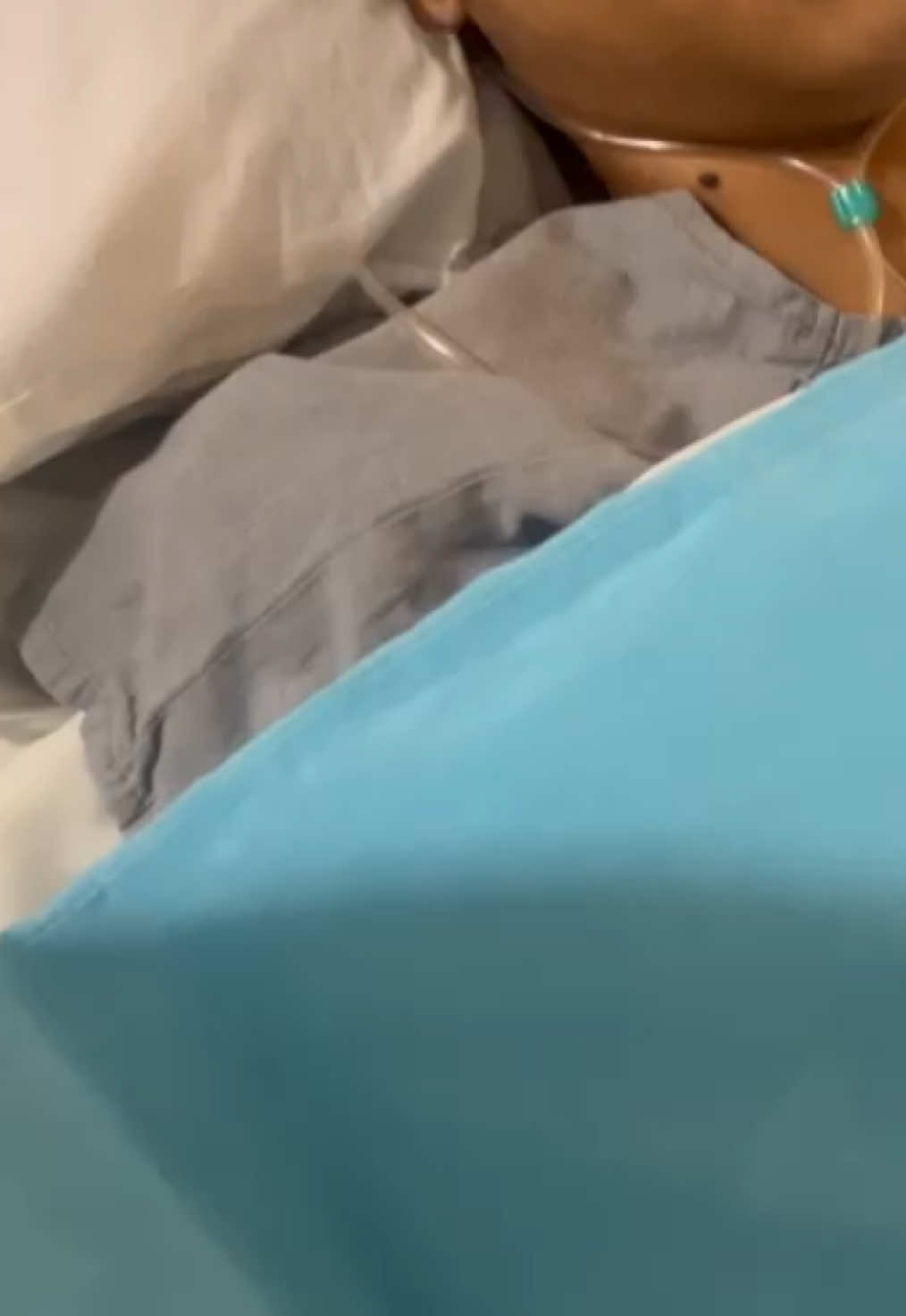 mds minha cara TODA inchada, ai eu tinha acabado de sair de uma cirurgia de correcao de escoliose no comeco de 2023….brutal KKKKKK💀#fyp 
