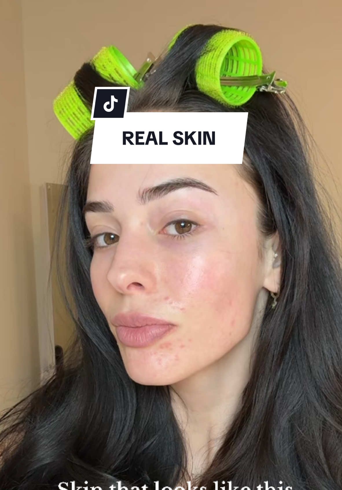 Lets just b honest, lets just b real #skin #perioraldermatitis #realskin #relatable #viralvideo 