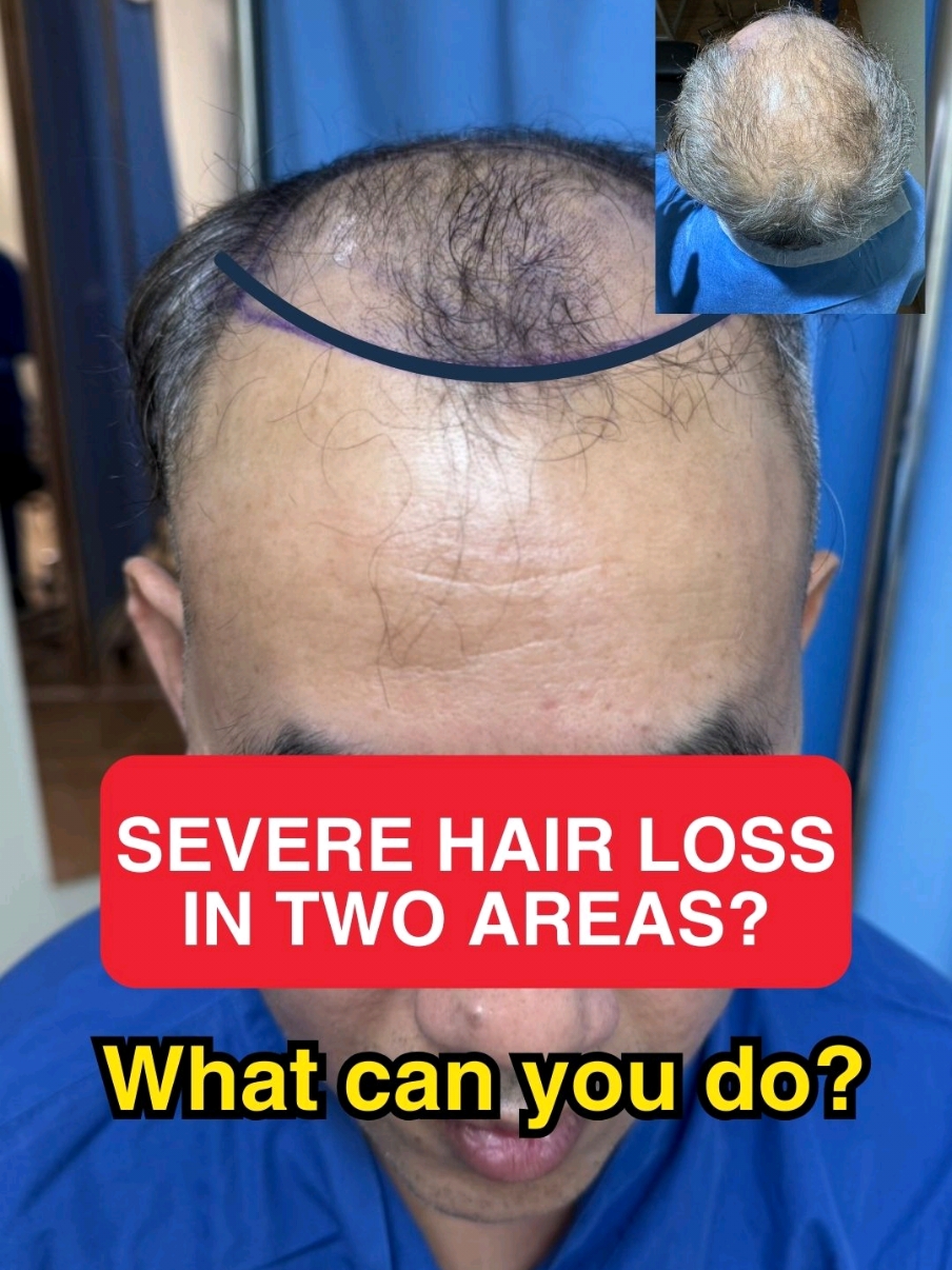 Hair Loss two area. how many hair graft?. What can we do⁉️ #hairtransplant #hairloss #hairtransplantbangkok #hairhospital 