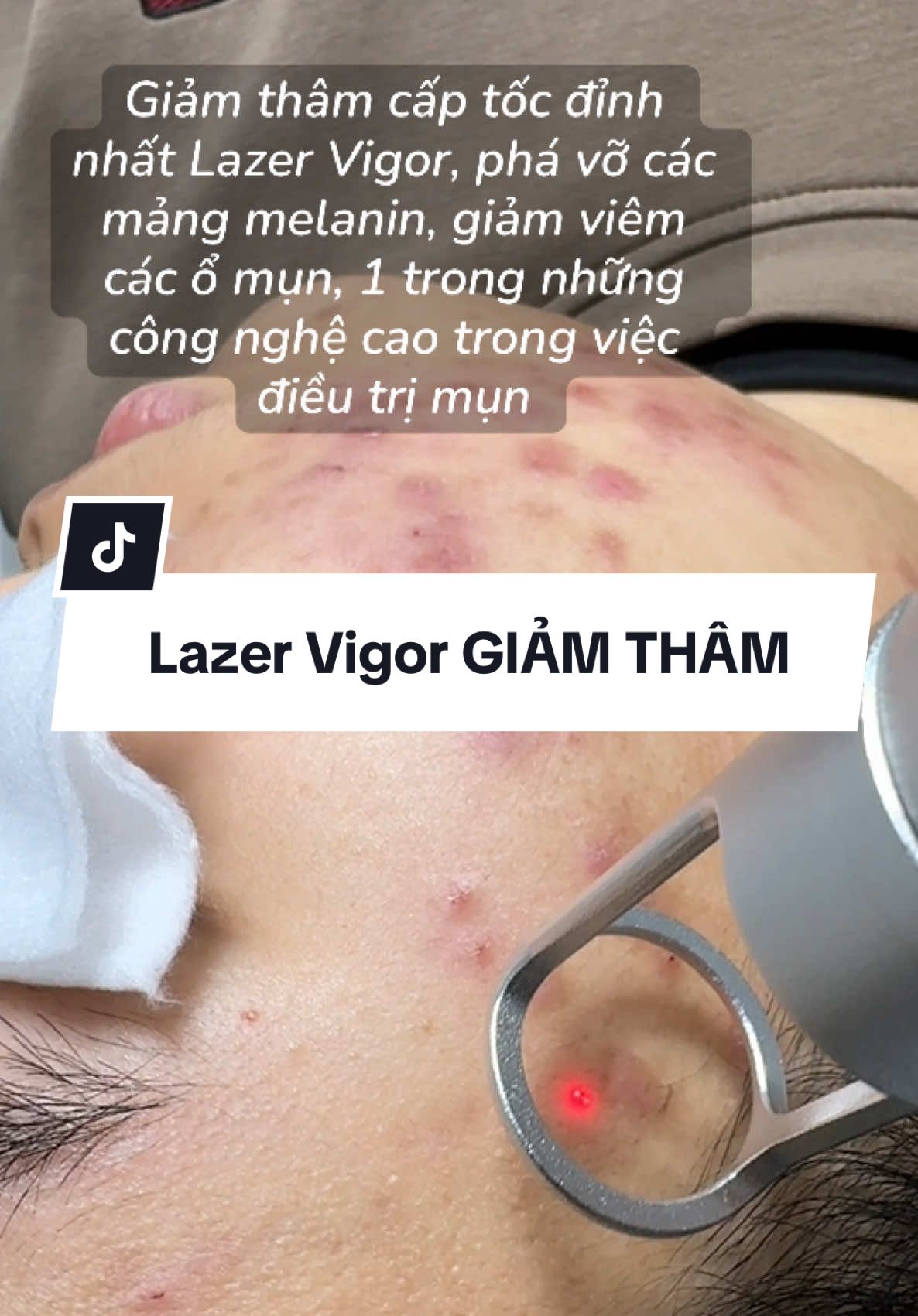 Lazer Vigor GIẢM THÂM cấp tốc #miaclinic 