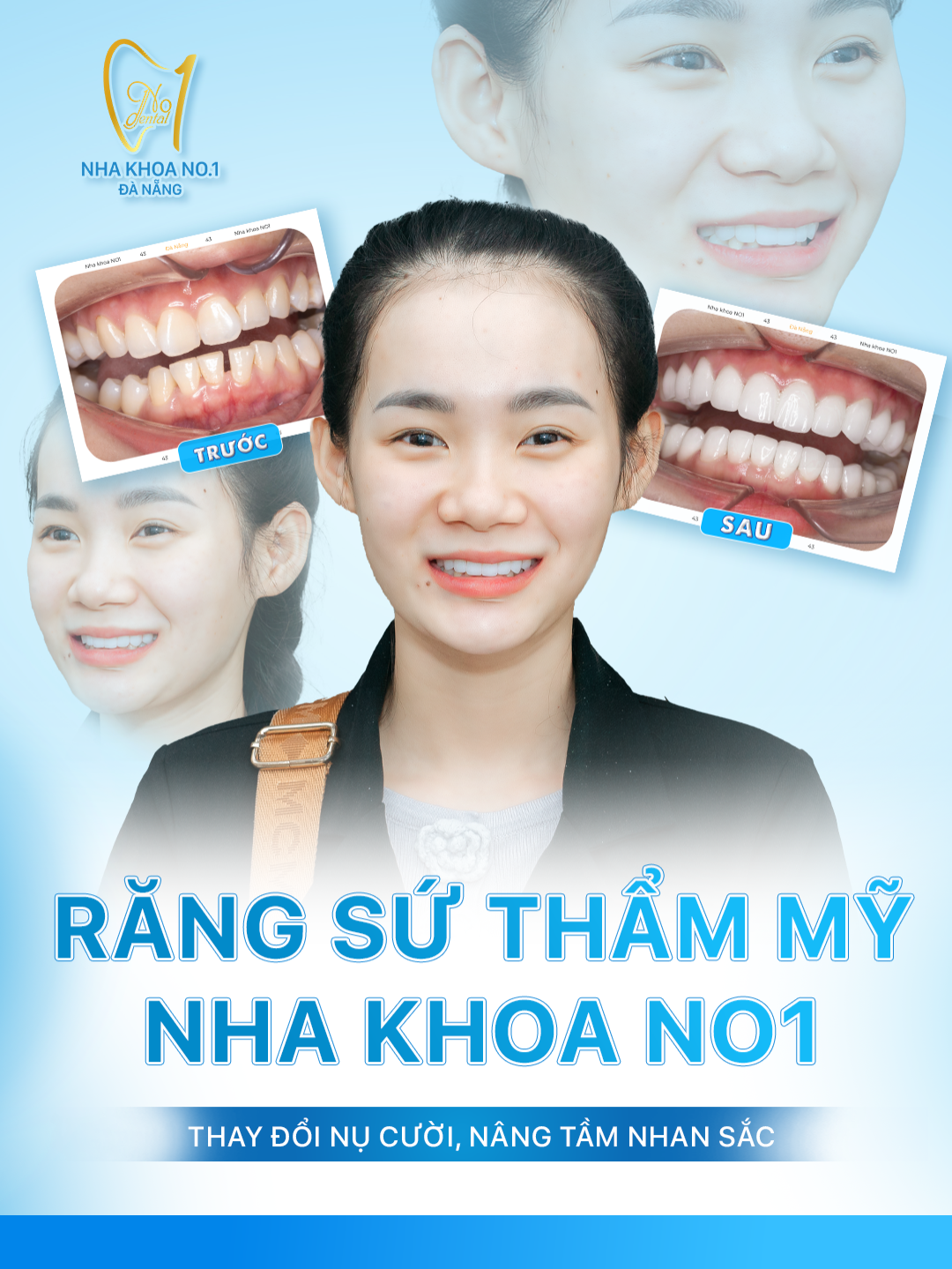 Răng sứ đẹp, Tết thêm duyên! Hoàn thành nụ cười mới đến với khách hàng tại nha khoa No1 Đà Nẵng #răng_sứ_thẩm_mỹ #răngsứ #no1dental #nhakhoano1danang #nhakhoano1 #nhakhoadanang #goclamdep