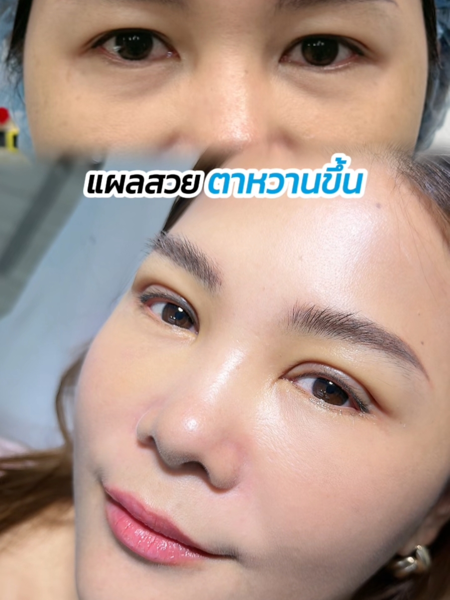 ตัดไหม #ทำตาสองชั้น ตาหวานไม่ง้อฟิลเตอร์ #สกายคลินิก #skyclinic #ทําตาที่ไหนดี #sweeteyes #ทําตาที่ไหนดี #รีวิวทำตาสองชั้น #ศัลยกรรมตา #รีวิวบิวตี้ #จักษุแพทย์ 