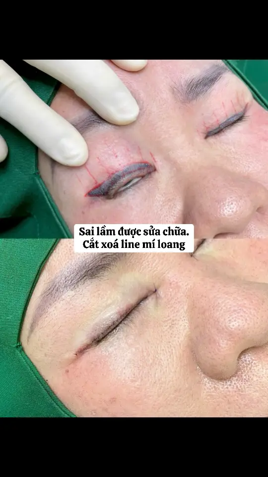 Hiệu quả ngay không cần xoá laser nhiều lần. 🫶🏻🫶🏻#THAMMYTHUYLE #phauthuatthammytunhien 