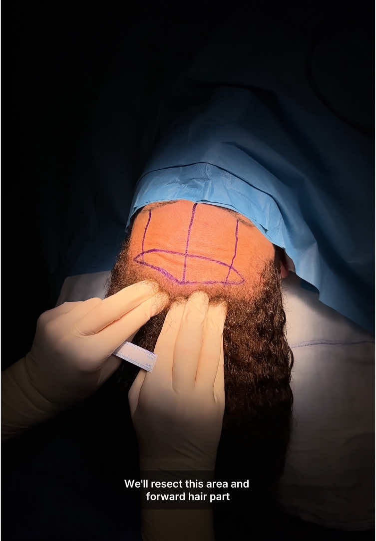 FOREHEAD REDUCTION 📐 9 cm to 6 cm  Our patient, who came to Istanbul from #Germany 🇩🇪, was concerned about big forehead 👳🏻‍♀️ Her forehead length which was 9 cm was reduced to 6 cm and thus an proportional and elegant apperance was obtained 🪄 📌 #foreheadreductionsurgery is an operation that takes about 1.5 hours under general anesthesia, you need to stay in hospital overnight and are discharged the next day, our patients can go back to their country on the 4th day after the operation ✈️ To get detailed information about the procedure:  Please contact our team via WhatsApp 📞☎️📲 🇬🇧 +90 (530) 069 76 86 🇹🇷 +90 (533) 085 76 86 #hairlinelowering #foreheadreduction  #alındaraltma #hairlinesurgery #plasticsurgery #drahmetdilber