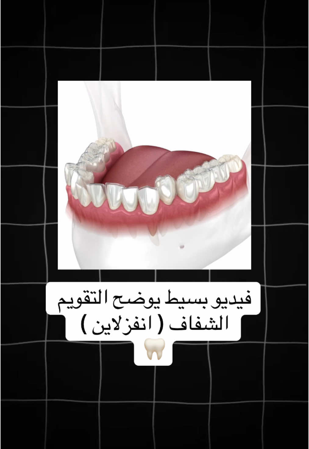 #طب_اسنان #طب_الاسنان #تقويم_الأسنان #التقويم_الشفاف #انفزلاين 