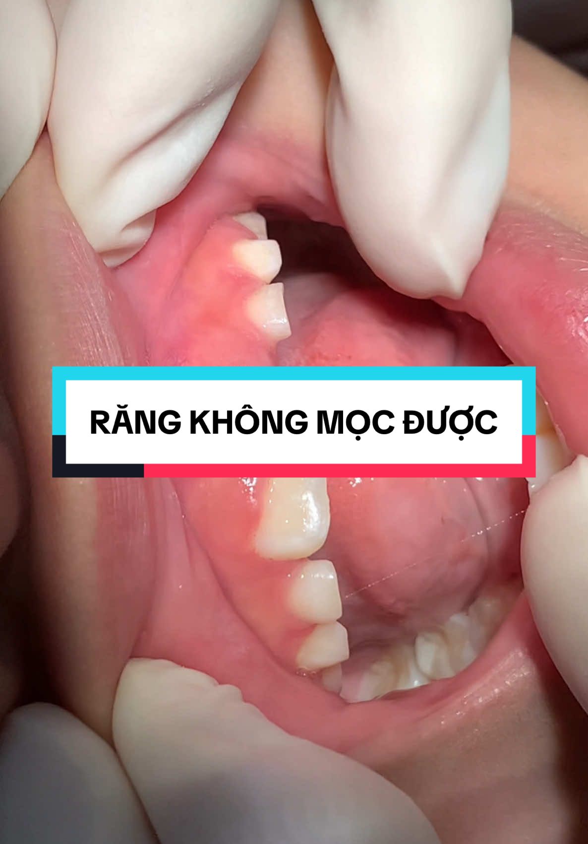 Nhổ răng sớm quá lợi co xơ lại răng không mọc ra nổi ý#bacthanhchuatuy 