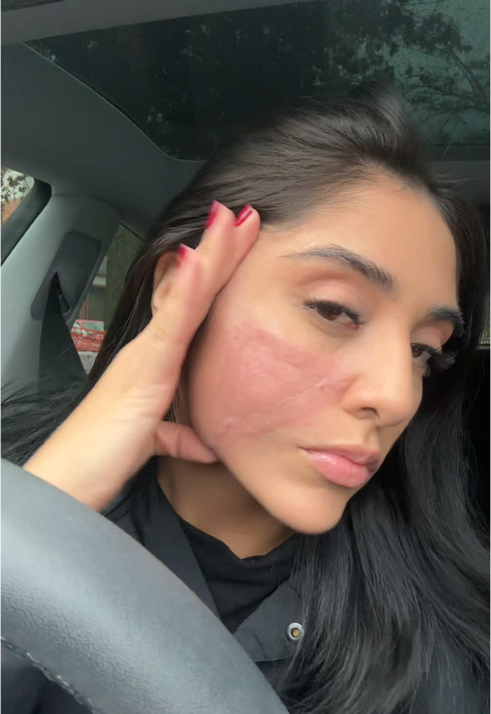 Scar update : ive lost track of how many treatments ive gotten but i think this is #12 .  We are doing every two months now until the scar is gone. They are also more intense since its not every 4 weeks.  It takes 1-2 weeks for my skin to heal from the treatment so i will follow this video with an update 🥰💗 #scar #scarsarebeautiful #skincancerawareness #sarcoma #dfsp #mohssurgery #cancersurvivor 