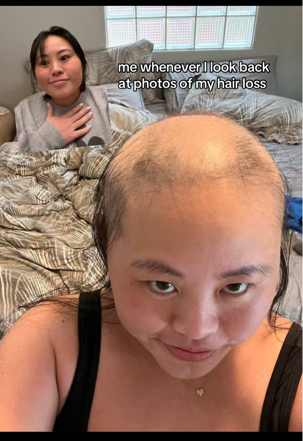 she was a bald headed baddie though 😘🥹🥲 #greenscreen #alopecia #hairloss #hairregrowth #hairjourney #hair #telogeneffluvium #myshayla #trend #bald  #baldheadedbaddie 