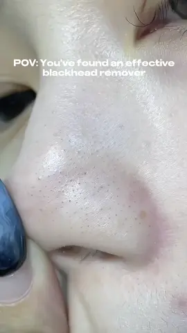 Stubborn blackheads OUT! The secret to clear skin ✨ #anlan #blackheadcleaner #skincaregoods Still worrying about blackheads, #AnlanBlackheadDevice helps you to solve blackheads and whiteheads problem easily, after using it, your skin is instantly fine and smooth, super healing! 💖 Two weeks to witness the pore thinning ~ Try it now! #DeepCleansing #PoreCare