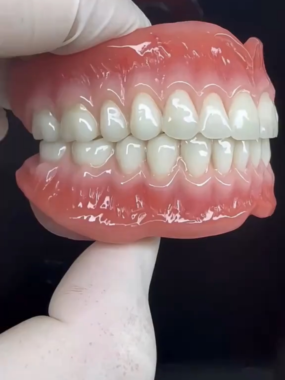 पूर्ण दन्तबनावट (Complete Denture) भनेको ती बिरामीहरूका लागि प्रयोग गरिने कृत्रिम दाँतहरूको सेट हो, जसले आफ्ना प्राकृतिक दाँतहरू पूर्ण रूपमा गुमाएका छन्। यसमा माथिल्लो र तल्लो दुवै जबडाका लागि कृत्रिम दाँत समावेश हुन्छन्। पूर्ण दन्तबनावटको मुख्य पक्षहरू 1. उद्देश्य: गुमेको चपाउने क्षमता पुनःस्थापना गर्नु। अनुहारको संरचना सुधार गर्नु। बोल्ने क्रममा हुने समस्या हटाउनु। 2. सामग्री: बेसको लागि ऐक्रेलिक रेसिन। दाँतहरू प्लास्टिक वा सिरामिकका। 3. प्रक्रिया: चेकजाँच र मोल्ड तयार पार्ने: बिरामीको मुखको मापन गरेर ढाँचाको तयारी गरिन्छ। डिजाइन र निर्माण: मोल्डअनुसार दन्तबनावट बनाइन्छ। फिटिङ र समायोजन: बिरामीको मुखमा राम्रोसँग फिट हुनेगरी एडजस्ट गरिन्छ। 4. फाइदाहरू: आरामदायी र सौन्दर्यपूर्ण देखिन्छ। दाँतको कामकाज पुनःस्थापित गर्छ। बिरामीको आत्मविश्वास बढाउँछ। 5. सम्भावित समस्या: सुरुवातमा असजिलो महसुस हुन सक्छ। समय–समयमा मर्मत गर्नुपर्ने हुन सक्छ। पूर्ण दन्तबनावटको हेरचाह हरेक दिन सफा गर्नुपर्ने। तातो पानी वा कठोर ब्रश प्रयोग नगर्नु। राति खोल्दा सुरक्षित ठाउँमा राख्नु। पूर्ण दन्तबनावटले दाँत गुमाएका व्यक्तिहरूलाई जीवनशैली सहज बनाउँछ। हाम्रा सेवाहरु: ✅ दाँत तथा मुख समबन्धी सम्पुर्ण समस्याको चेकजाँच (Check-up/OPD) ✅ नदुखाइ दाँत जरैदेखि भर्ने (Painless RCT/Re -RCT) ✅नमिलेको दाँत मिलाउने (Dental Braces/Clear Aligners) ✅ दुखिरहेको दाँत नदुखाइ निकाल्ने (Painless Tooth Extraction) ✅ डेण्टल डायमोंड  रखने / दाँत ब्लीचिंग गर्ने ( Diamond/Teeth Bleaching ,Whitening Service) ✅ मेसिन द्वारा दाँत सफा गर्ने (Scaling& Polishing) ✅ कृतिम दाँत रोपने (Dental Implants) ✅ बुद्धिबाङ्गारा निकल्ल्ने (Wisdom Tooth Extraction(Nonsurgical/Surgical) ✅ दाँतमा सिमेन्ट भर्ने (Tooth colour Cement Filling/composite/GIC) ✅ बुढा बुवा आमाको पुरै नयाँ सेट दाँत बनाइ लगाइदिने (complete Denture) ✅ Metal Ceramic एवम Zirconia को खोल हालिने(Dental Cap/Crown) ✅ मुखमा भएका घाउ खटिराको उपचार गर्ने(Oral Ulcer/wound) ✅ बालबालिकाको दुखेको वा दाँत सम्बन्धी सम्पूर्ण समस्याहरूको उपचार गरिने दाँत तथा मुख स्वास्थ्यको कुनैपनि समस्याहरु देखा परेमा हामीलाई सम्पर्क गर्नुहोस। थप जानकारीको लागि :  +977 976-7264950 थापाथली काठमाडौं। #healthy #healthcare #healtyteet #teethcare #teeth #oralhealth#fixedpartialdenture #patientsafety #patientsatisfaction #dentalcare #dental #teethcare #dentalhealth #dentalclinic#dentalcheckup #oralhygiene #oralcare #tooth #dentalimplants #orthodontics #healthyteeth #smilemakeover#heal@Kathmandu polyclinic(KPC) @sweety @pankajmehta057 @drbenujabhandari 