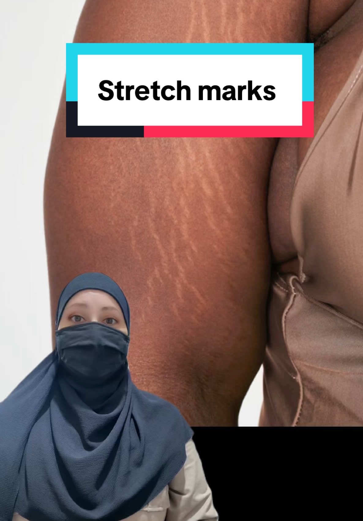 #stretchmarks #stretchmarkremoval #tretinoin #contratubex #perfectil #stretchmarks 