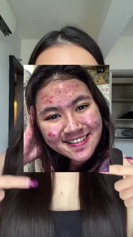 Perjuangan yang sangat luar biasa tidak mudah. Tapi belajar banyak banget dari perjalanan acne journey ini🥺 Basic skincare + bahan aktif adalah skincare routine terbaik untuk mengatasi jerawat dan jangan lupa sunscreen, gak kalah penting😭 Salah satu hal paling membantu untuk menghilangkan bekas jerawatku dulu adalah sejak aku mulai pakai sunscreen setiap hari. Proses memudarnya bekas jerawatku jadi jauh lebih cepat. Dan emang dulu awal-awal aku selalu pakai physical sunscreen. Bahkan sampai sekarang masih lebih suka physical dibanding chemical sunscreen. Best untuk kulit sensitive dan acne-prone skin🙏  #Unitary #physicalsunscreen @Unitary Beauty 
