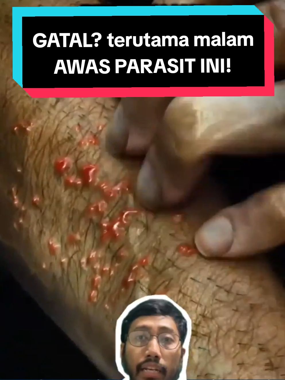 GATAL terutama malam hari, terutama di sela jari dan lipatan tubuh? mungkin itu parasit yang hidup di baju, sprei dan selimut, bisa menular, SCABIES namanya #gatal #gatalgatal #gataldikulit #scabies #skabies 