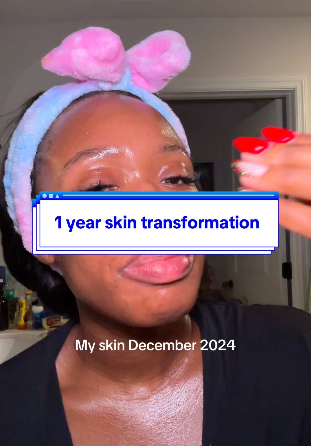 1 year skin transformation #oilyskin #skincare #blackskincare #tretinoin #SkinCare101 #koreanskincare #skintok #tretinoinjourney #acneskin #darkmark #acnescars 