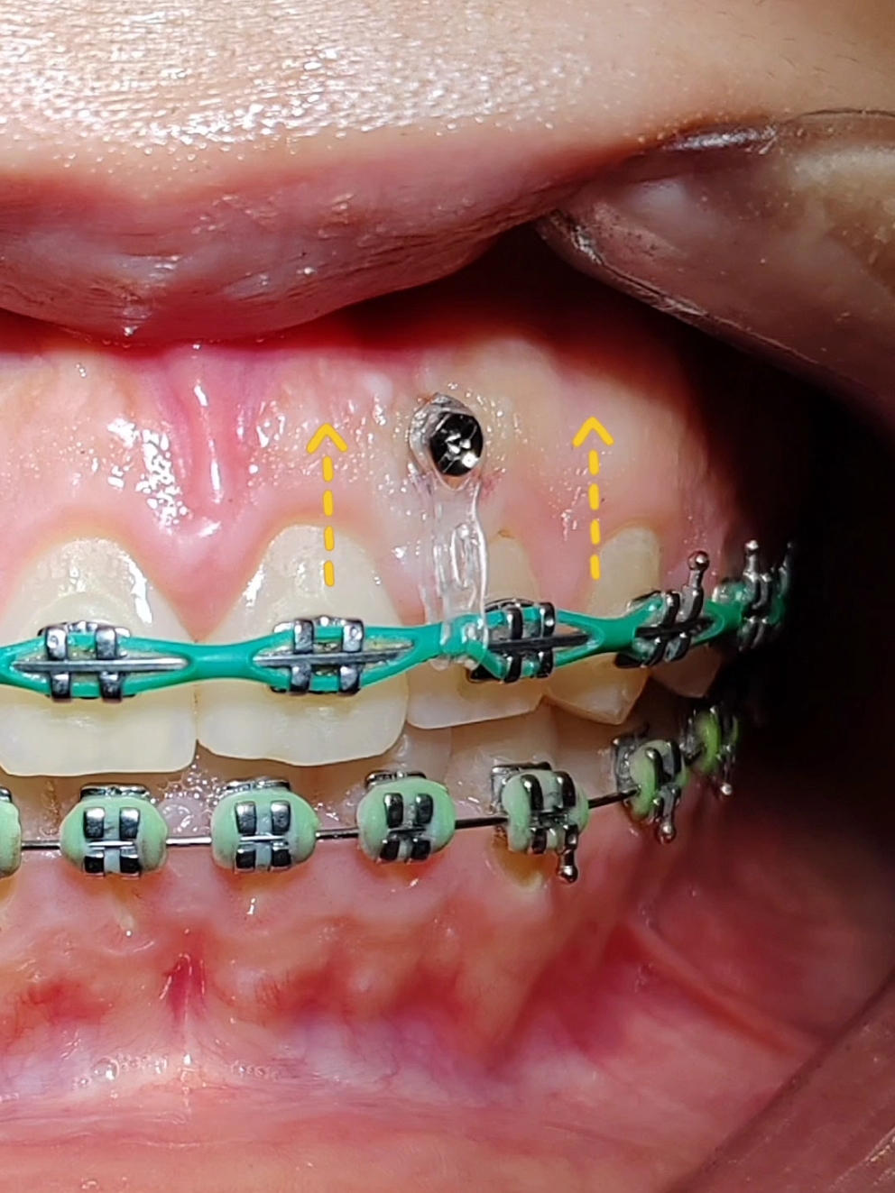 سحب الفك العلوي لأعلى لعلاج الضحكة اللثوية #ضحكة_لثوية #ابتسامة_لثوية #تقويم_الاسنان #دكتور_محمد_عرنوس #Nublê 