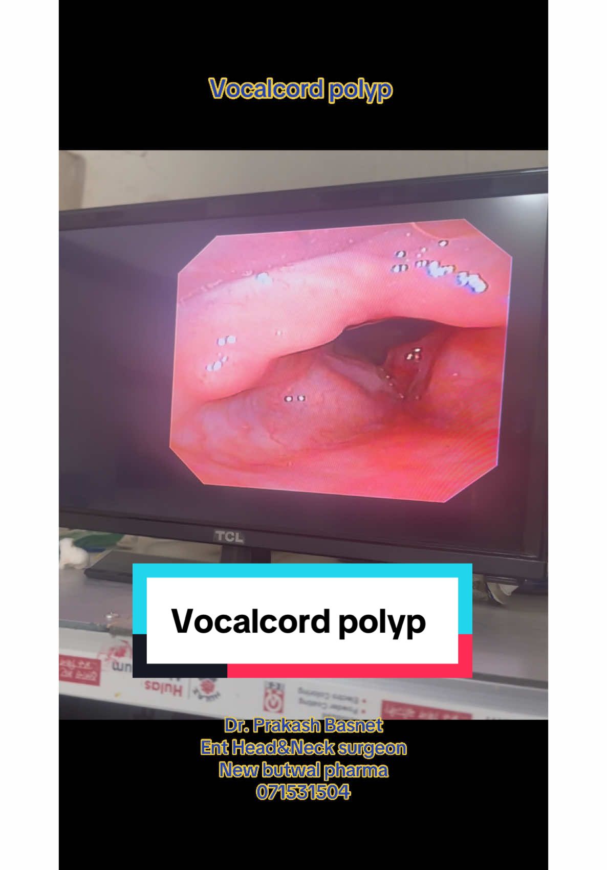 #vocalcordpolyps #foryou #viral #trending #fyp #entdoctorbutwal #ent #fypシ゚viral 