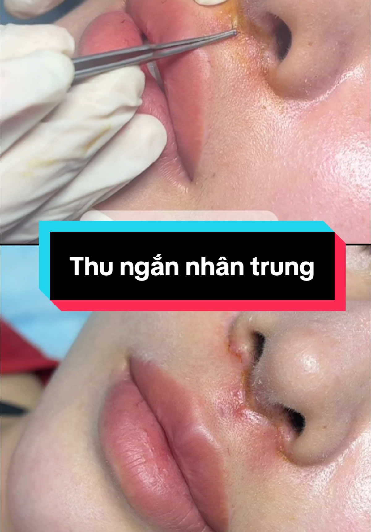 Nhân trung sau 6ngay căt chỉ và kết quả hoàn thiện. Đẹp mê ly…#thammynoikhoa #midang #thungannhantrung 