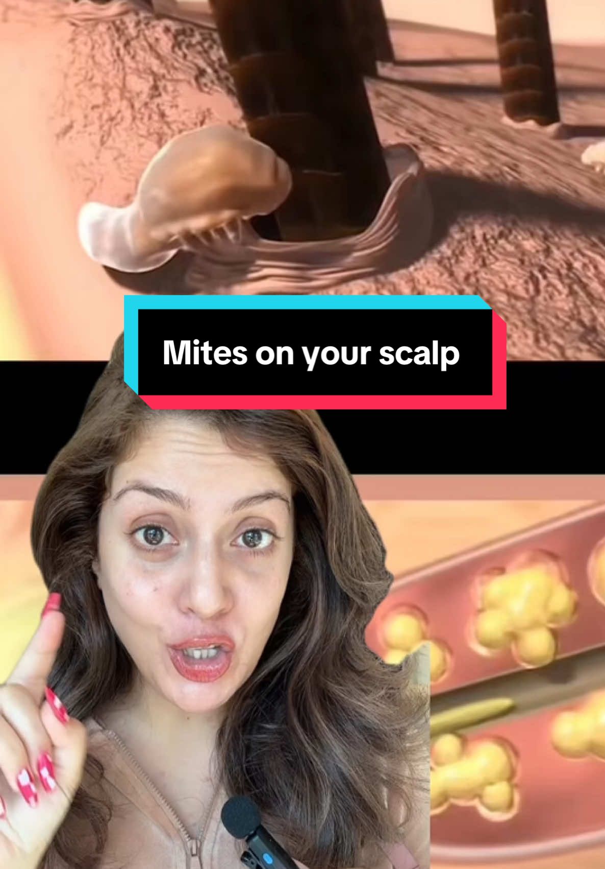 An Internet trend that needs to die is scalp training. I have been a personal victim to this trend two & half years ago where I was suffering from massive hair fall. That is when I saw Trichologist and he guided me on what proper hair and scalp hygiene should be.  Demodex infestation of the scalp may be associated with a clinical presentation of folliculitis, characterized by hair loss, scalp erythema, scaling  You can also develop demodicosis.  The symptoms of demodicosis appear very suddenly, seemingly overnight. You may experience any of the following: * Burning sensation. * Itchiness. * Pustules that look like whiteheads. * Redness. * Rough feeling on your skin, like sandpaper. * Scales, perhaps resembling eczema. * Sensitive skin. * White sheen on your skin or eyelashes. If you suspect you have an infestation of Demodex mites that’s causing symptoms, talk to your healthcare provider or a dermatologist. #hair #haircare #skincareproducts #skincarecommunity #skintok #skincareproducts #uae🇦🇪 