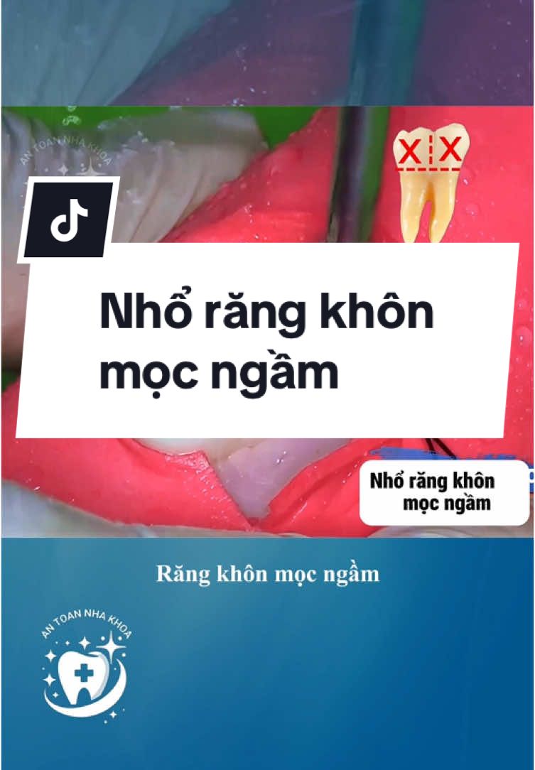 Nhổ răng khôn mọc ngầm sẽ như thế nào ? #LearnOnTikTok #antoannhakhoa #nhakhoa #rang 