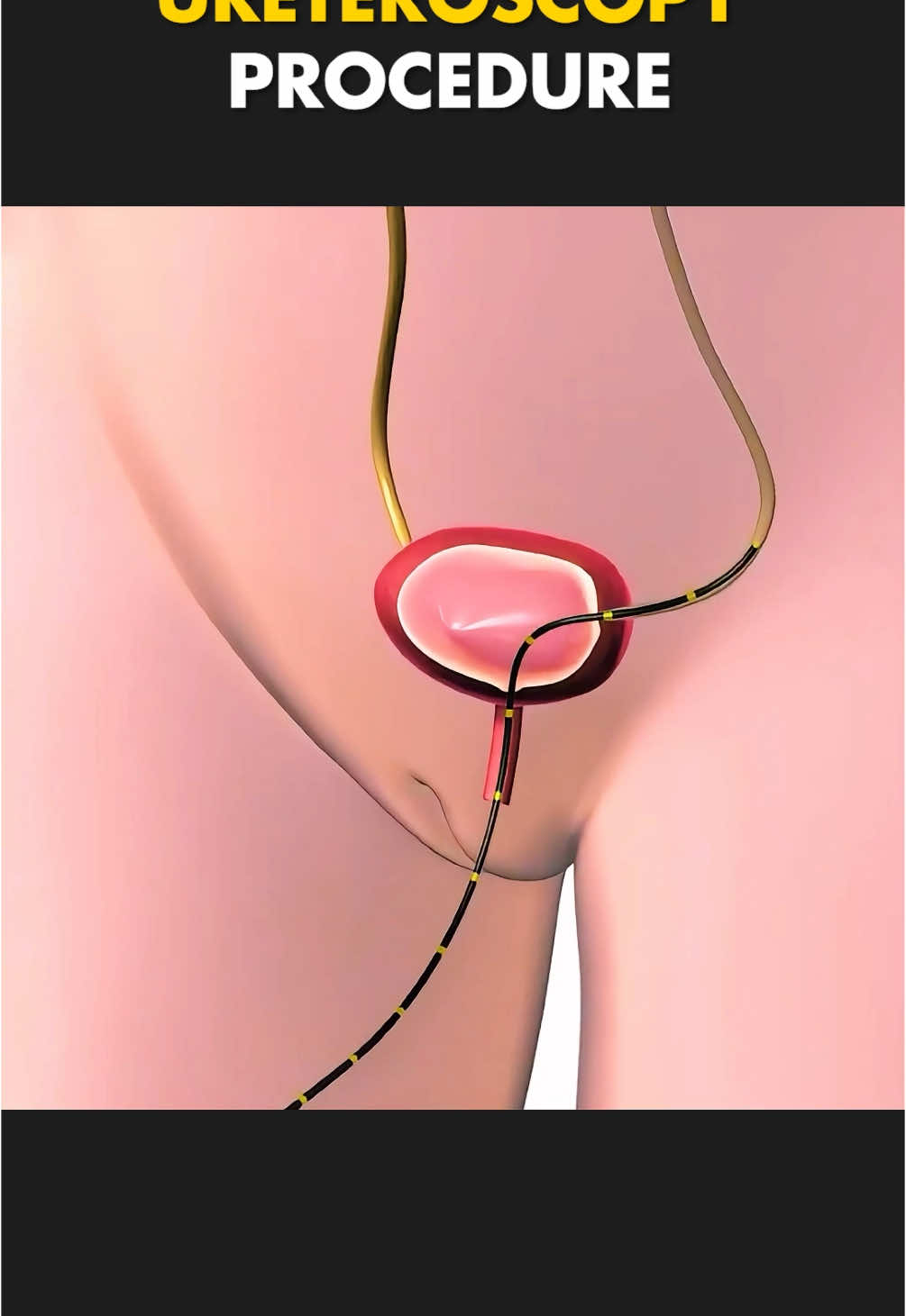 Ureteroscopy Procedure (3D Animation) #ureteroscopy #ureteroscope #uterusproblems #kidneystone #kidneystones #kidneystonesremoval #ureteroscopy_stone_removal #ureteroscopy_with_laser_lithotripsy #medical3danimation #3dmedicalanimation #kidneystonesurgery #kidneystonesurvivor 