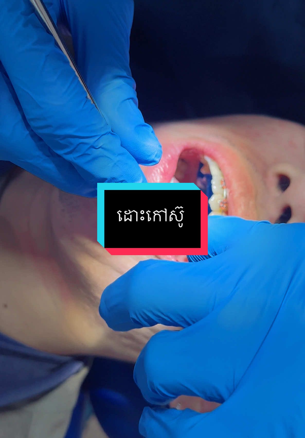 Check up ដូរកៅស៊ូ  #គ្លីនិកធ្មេញគ្រេតស្មាល #greatsmiledentalclinic #ព្យាបាលធ្មេញ #teamធ្មេញដែក #fyp #ពត់ធ្មេញ #braces #ធ្មេញដែក 