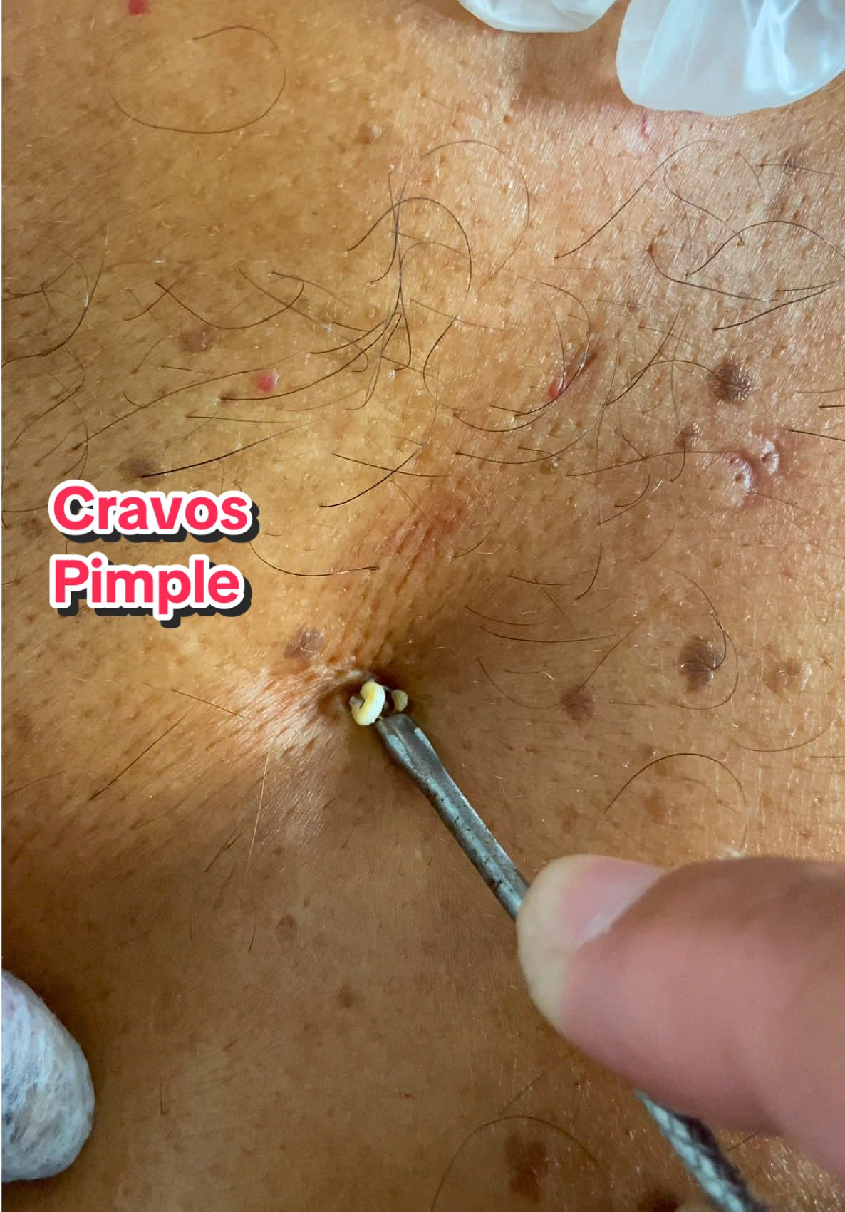 #fyp #cuidado #cravos #limpezadepele #limpieza  #pele #pimple #blackhead #natal #cravos #puntos #viral_video #satysfying #seguidores #tik  #reels #fyp #fypp #fypdong #pimple #pimplepop #viral_video #viralvideos #cravoseespinhas #blackhead #vaipraforyou #foryoupage #foryou #fyppp menos 279 § Beyonce - @AMARNI