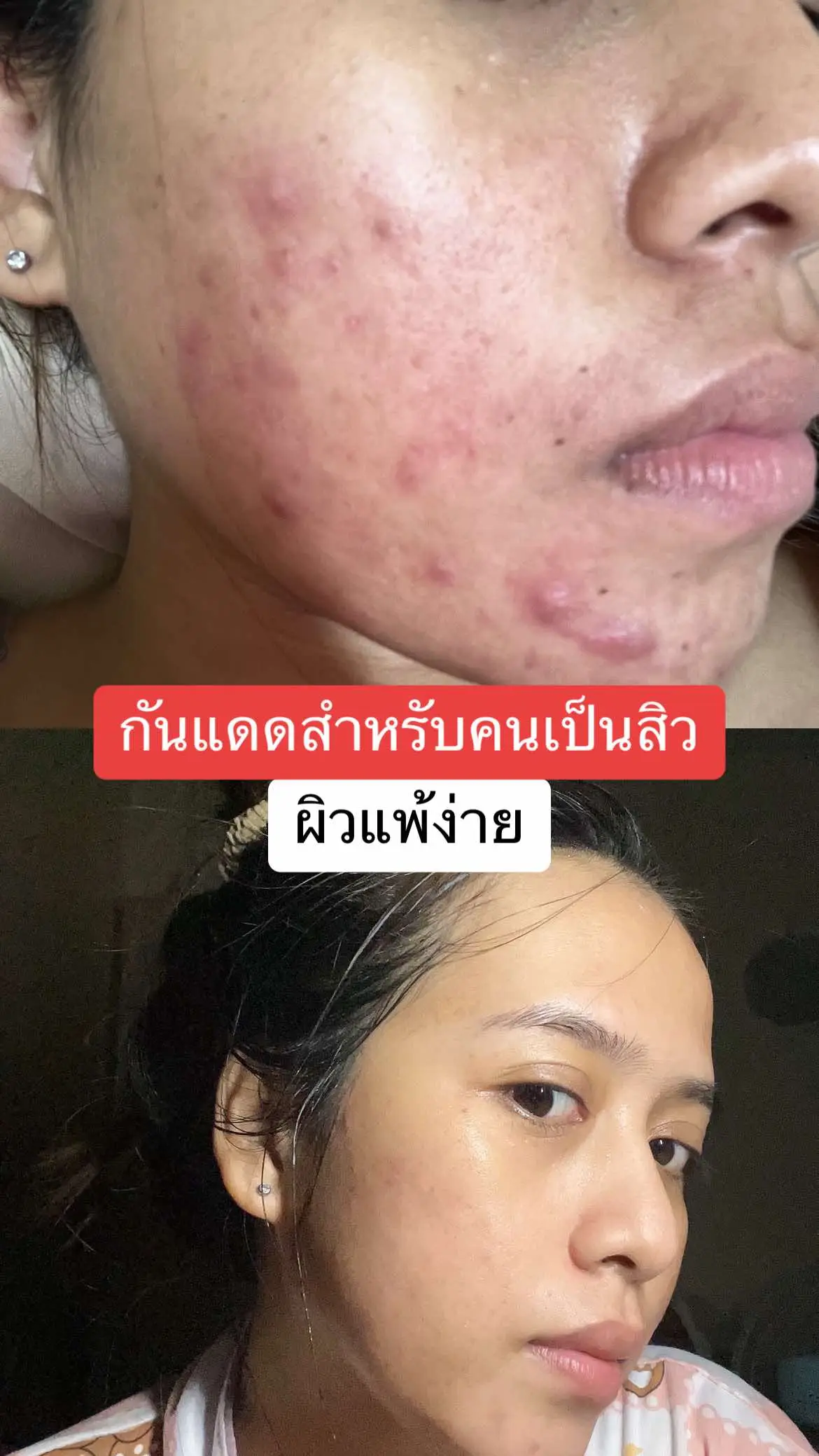 #ผิวติดสาร #เปิดการมองเห็น #เปิดการมองเห็นเถอะ #เทรนด์วันนี้ #ผิวแพ้ง่าย #สิวฮอร์โมน #สิวอักเสบเรื้อรัง #สิวไต #รักษาสิว #รักษาสิว #สิวไต #แต่งหน้าปิดสิว #รักษาสิว #รักษาสิวให้มีความสุข #สิวฮอร์โมน #ผิวติดสารสเตียรอยด์ #รักษาสิวให้มีความสุข #ผิวติดสารสเตียรอยด์ 