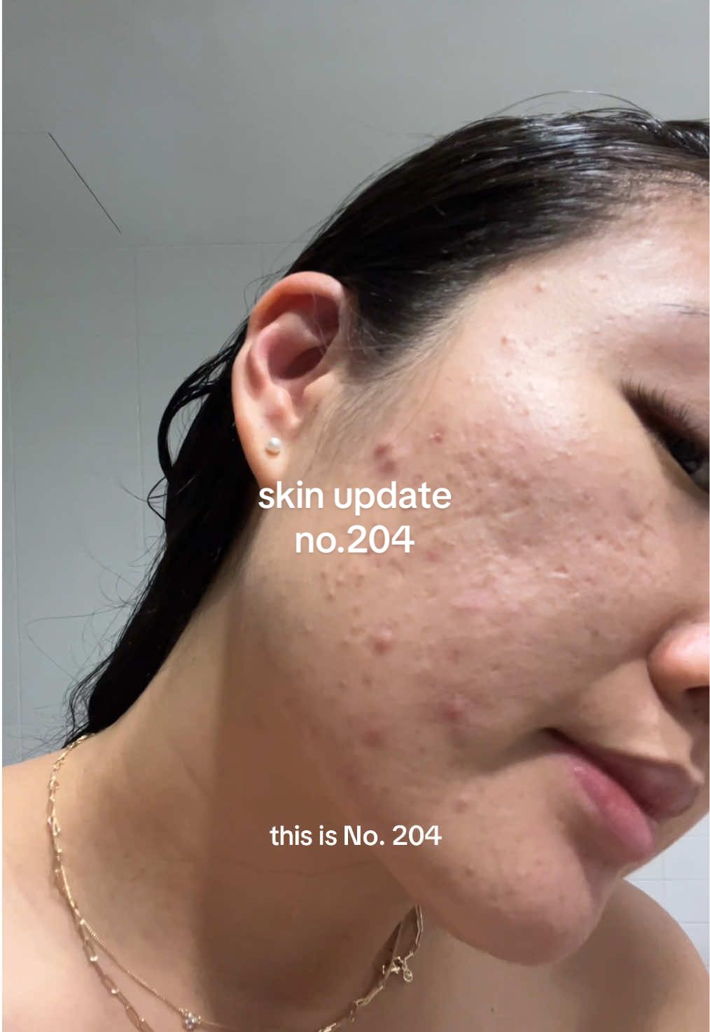 Skin update no.204. Santa, all I want for Christmas is clear skin 🎄🙏🏼😀 4 more sleeps till I’m in Korea for my holidays ✨  #acnejourney #breakoutskin #pimples #acnefighter #acneproneskin #acneskin #hormones #fyp