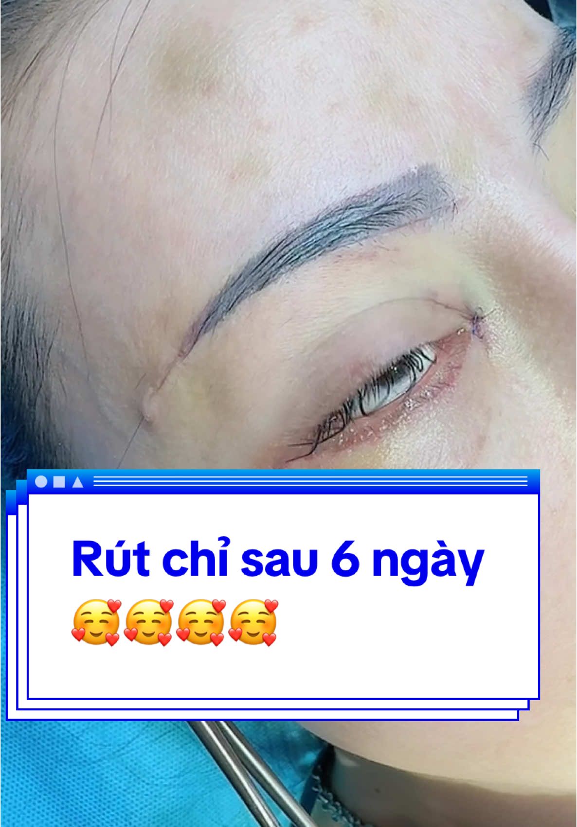 Rút chỉ sau 6 ngày  🥰🥰🥰🥰#Tuyết_Diamond #Khâu_rút_chỉ #videoviral #xuhuong #Nâng_cung_chân_mày 