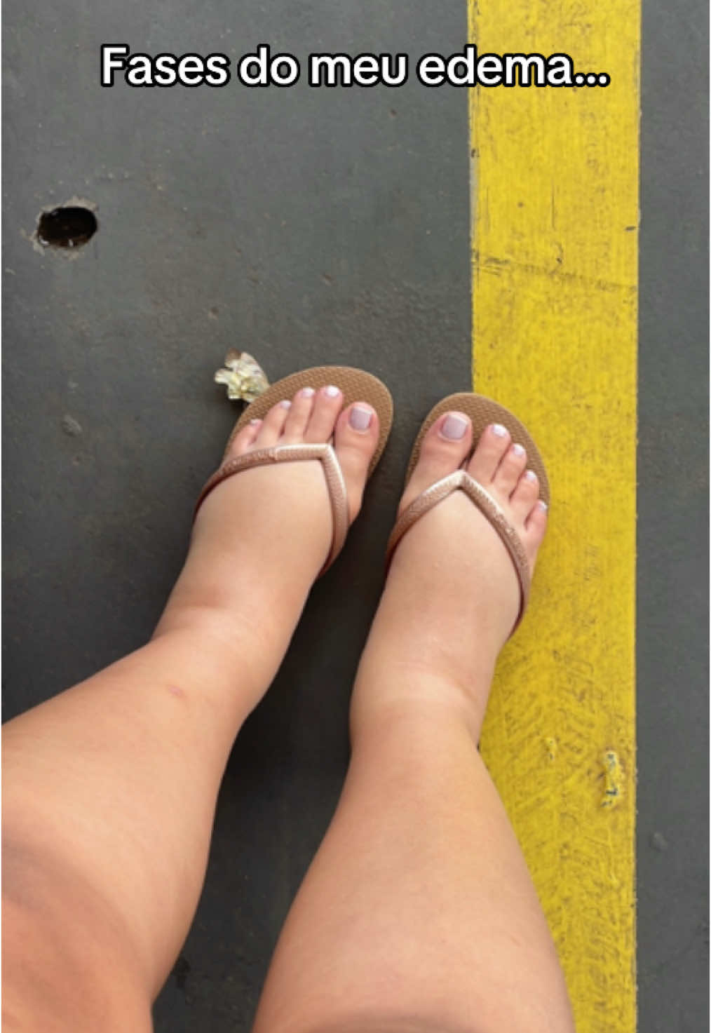 Até ter meu diagnóstico foi muitos inchaços “inofensivos”                                #doencasraras #autoimmune #raissaclara #fypp #edema #gesf #informativo #meducina 
